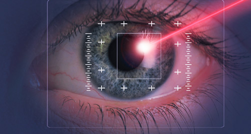 LASIK eye surgery